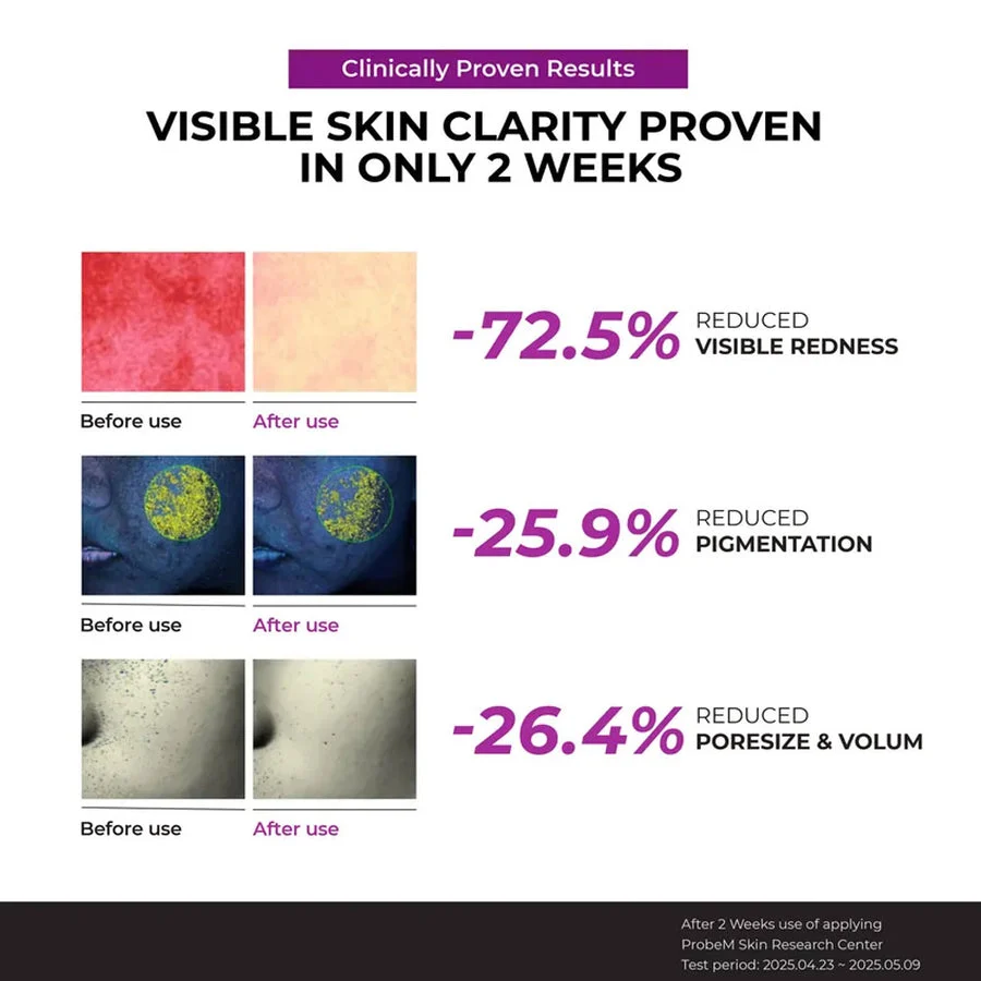 Jumiso Niacinamide 10 Serum 40ml 3 Jumiso Niacinamide 10 Serum before and after 2 weeks clinical results for redness reduction and pore size volume.